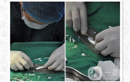 膨體隆鼻后期*果自然嗎?山根會不會變矮一些?