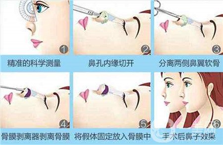 膨體隆鼻術(shù)后注意事項(xiàng)有哪些？需要忌口嗎？