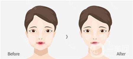 去頰脂墊幾天消腫?多久才能正常吃飯?