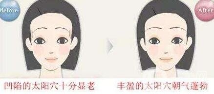濟(jì)南自體脂肪填充太陽(yáng)穴價(jià)格貴不貴?