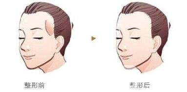 濟(jì)南自體脂肪填充太陽(yáng)穴價(jià)格貴不貴?