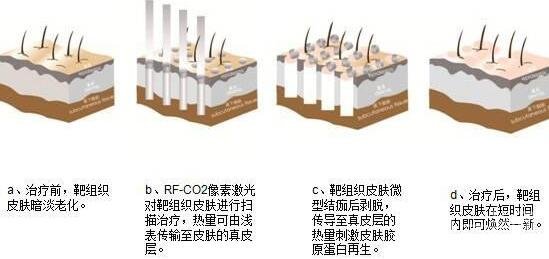 像素激光調(diào)節(jié)痘疤要多少錢?要做幾次?