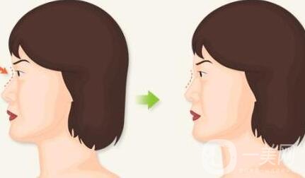 注射膠原蛋白隆鼻好嗎?