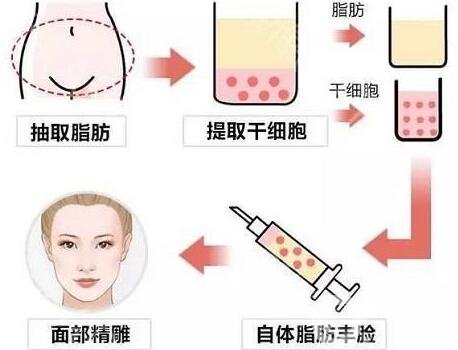 自體脂肪臉部填充可以管多久?要注意哪些?