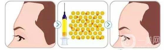 自體脂肪填充額頭不想要了怎么辦?