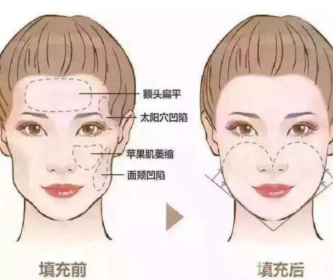 自體脂肪填充臉部會痛嗎?風險有哪些?