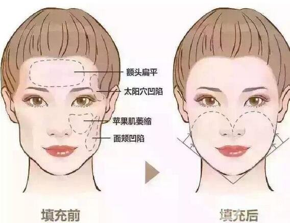 自體脂肪填充面部后注意事項(xiàng)有哪些?