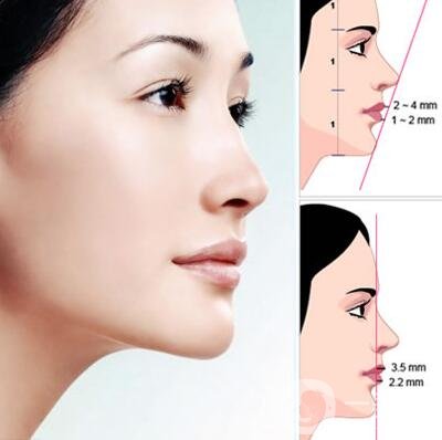 自體脂肪填充下巴