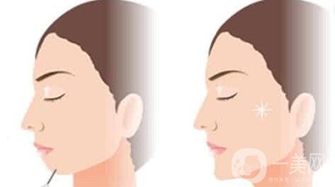 自體脂肪填充下巴