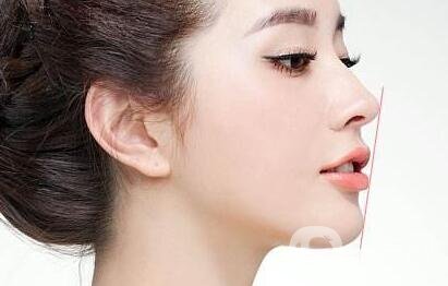 自體脂肪填充下巴