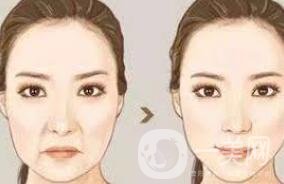 自體脂肪填充法令紋