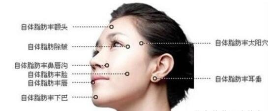 自體脂肪填充減少抬頭紋