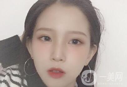 自體脂肪填充減少抬頭紋