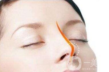 現(xiàn)在這個行情墊個鼻子多少錢?貴不貴?