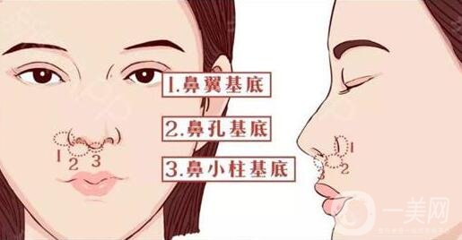 在韓國(guó)做鼻子要多少錢(qián)?比國(guó)內(nèi)的貴嗎?