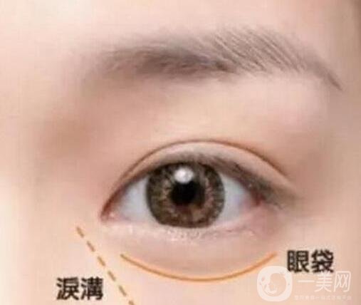 淚溝自體脂肪填充術(shù)后有些腫正常嗎?會(huì)恢復(fù)嗎?