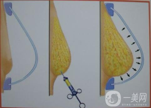 上海自體脂肪填充隆胸價(jià)格大概要多少錢(qián)?