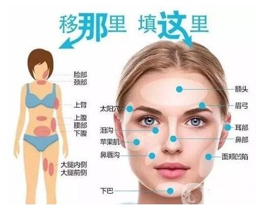 自體脂肪填充面部多少錢?大概價位是多少?