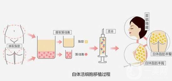 自體脂肪填充的利弊分別有哪些?