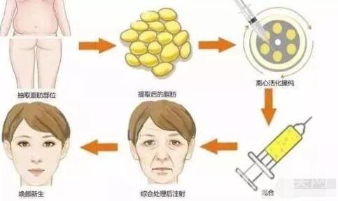 自體脂肪填充副作用及后遺癥是什么?