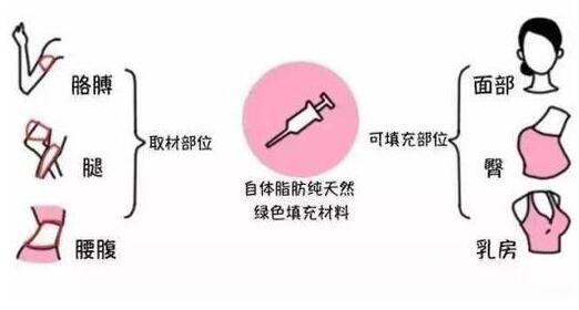 自體脂肪填充介紹?全國(guó)哪些機(jī)構(gòu)做得好?