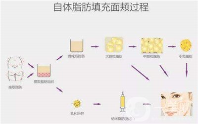 北京自體脂肪填充醫(yī)院有哪些？好的有哪些？