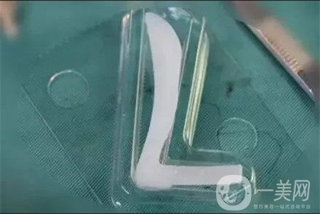 假體隆鼻*果如何？多久可以看到*果呢？