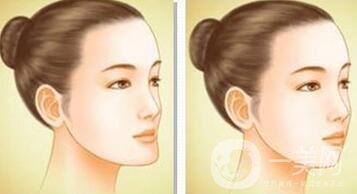 下巴突出怎么整？矯正手術原來是這么做的