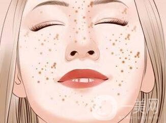 如何去蝴蝶斑不反彈?正確的方法在這里!