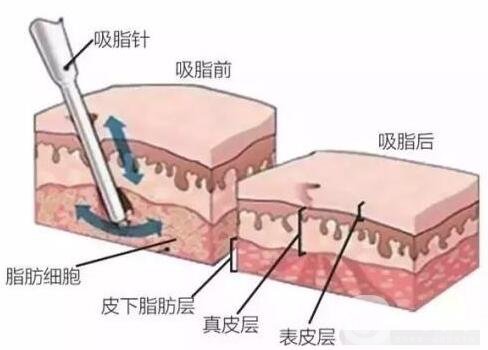 上臂吸脂減肥術(shù)靠譜嗎?能細(xì)多少?
