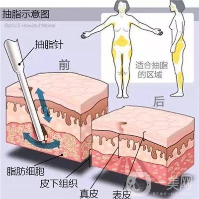 腰腹環(huán)吸后要腫多長時(shí)間呢？可以活動(dòng)嗎？