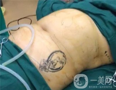 腰腹環(huán)吸后要腫多長時(shí)間呢？可以活動(dòng)嗎？