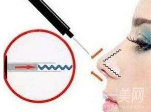 自體軟骨隆鼻整形疼嗎？*嗎？