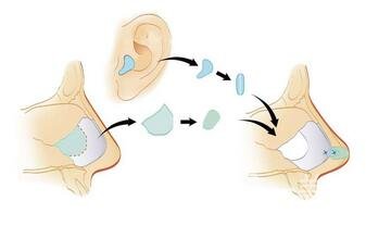 自體軟骨隆鼻整形疼嗎？*嗎？