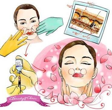 注射玻尿酸是整容嗎?能帶來哪些變化?