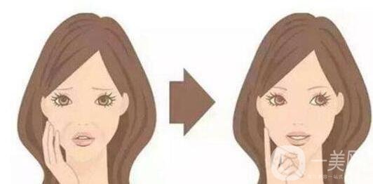 注射除皺新方法有哪些?*果怎么樣?