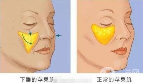 注射填充蘋(píng)果肌之后能笑嗎?會(huì)僵硬嗎?