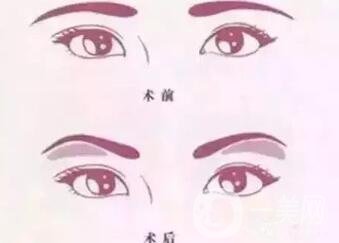 玻尿酸眉弓填充怎么打？會下滑嗎？