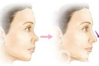 朝天鼻怎么整形？手術(shù)神秘面紗揭幕