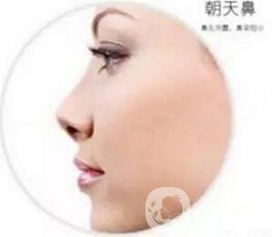 朝天鼻怎么整形？手術(shù)神秘面紗揭幕