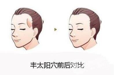 自體脂肪填充太陽穴危險嗎?有哪些風險可以提前規(guī)避?