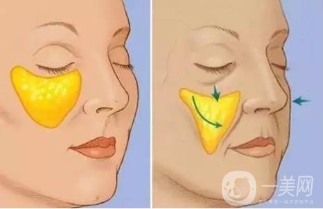 自體脂肪填充蘋(píng)果肌需幾次手術(shù)才能*果?