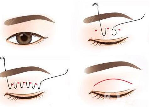 埋線法做雙眼皮費(fèi)用是多少?