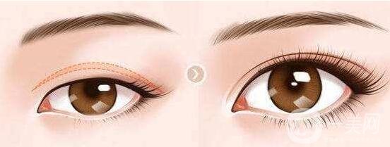 上瞼下垂手術(shù)要多少錢(qián)?貴嗎?