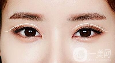 割雙眼皮過程大概需要多長時間?