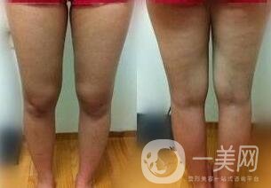 全身吸脂減肥價格