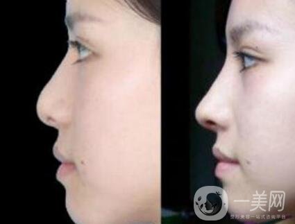 假體隆鼻手術(shù)