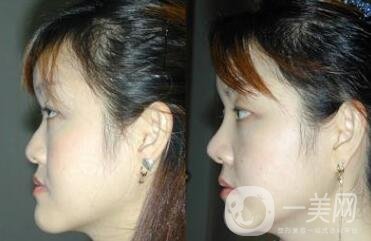 假體隆鼻手術(shù)