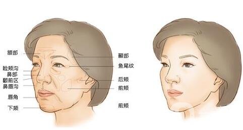 面部脂肪填充吃什么成活率高？