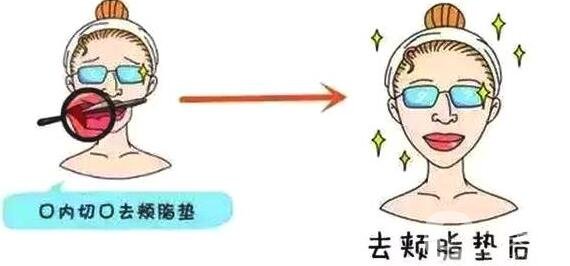 去頰脂墊價(jià)格貴嗎?要多少錢?